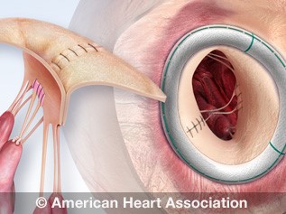 Heart valve repair illustration