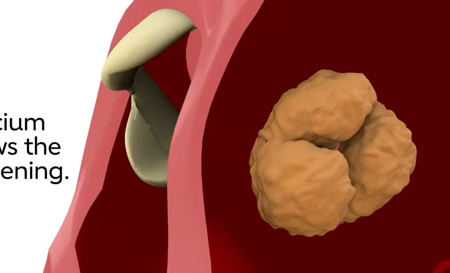 What is aortic stenosis video