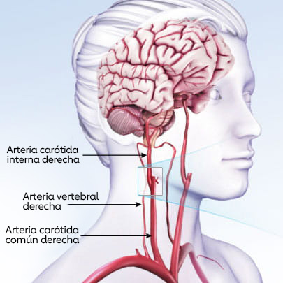 illustration of a translucent person showing their brain, right internal carotid artery, right vertebral artery, and right common carotid artery